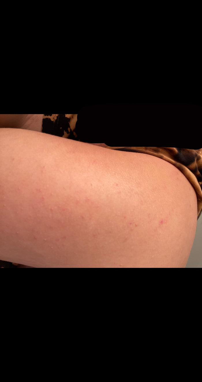 Julie M. — avis Kurv+ soin corps boutons et taches